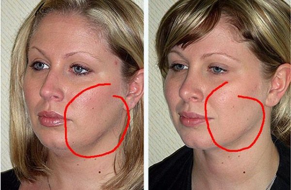 Удаление комков Биша. Фото до и после, последствия, реабилитационный период. Как убрать без операции