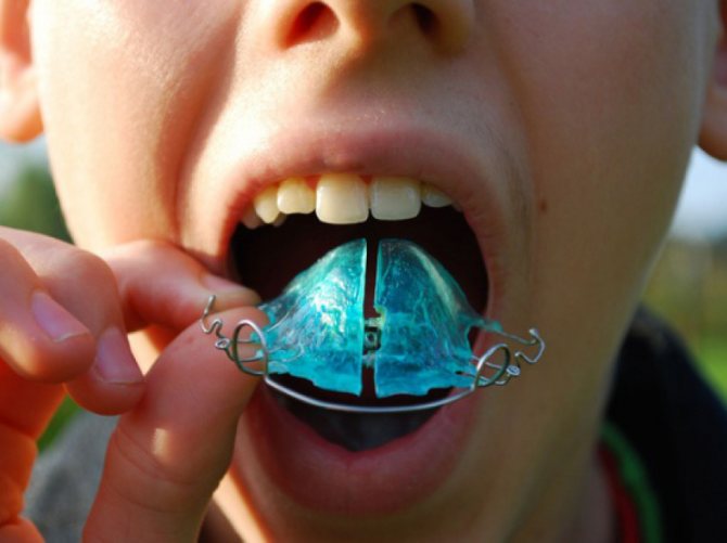 Установка аппарата Брюкля