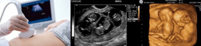 узи многоплодной беременности