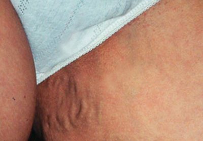 варикоз беременность