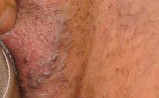 варикоз половых губ беременность