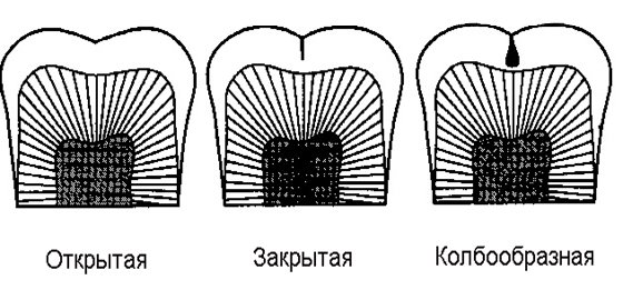 Виды фиссур