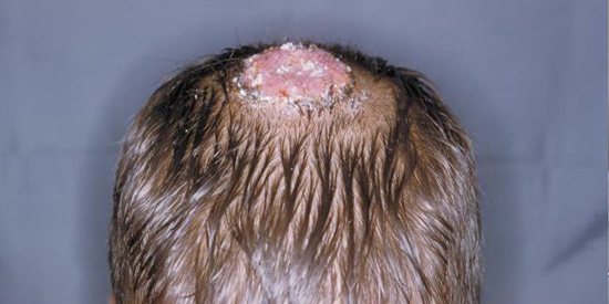 воспалительный процесс на коже головы