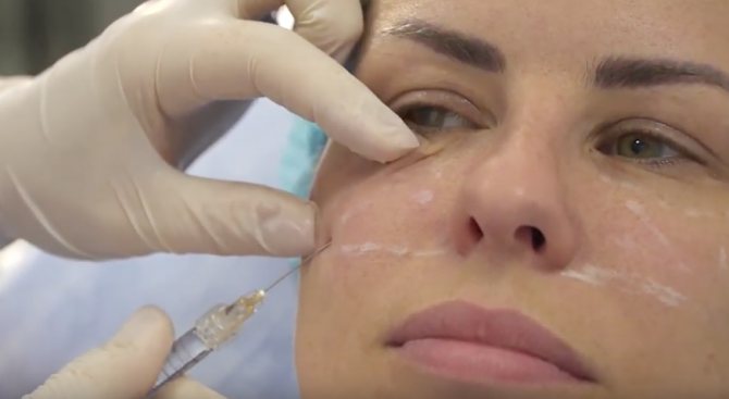 введение Neuramis