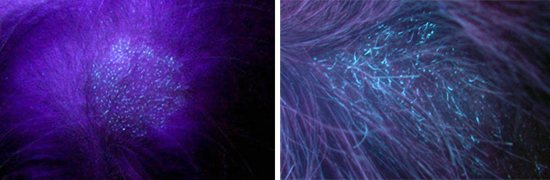 выявление микроспории лампой вуда