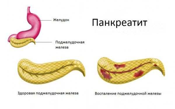 fibroz-i-lipofibroz-podzheludochnoj-zhelezy1