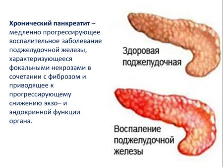 Хронический панкреатит
