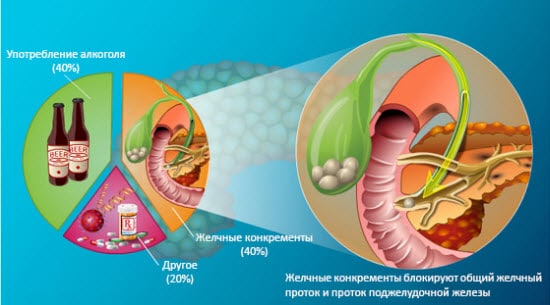 pankreatit-simptomy3