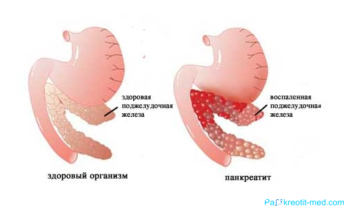 признаки заболевания поджелудочной железы симптомы и лечение