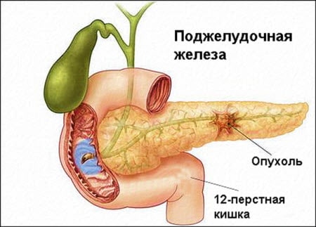 Раком поджелудочной железы