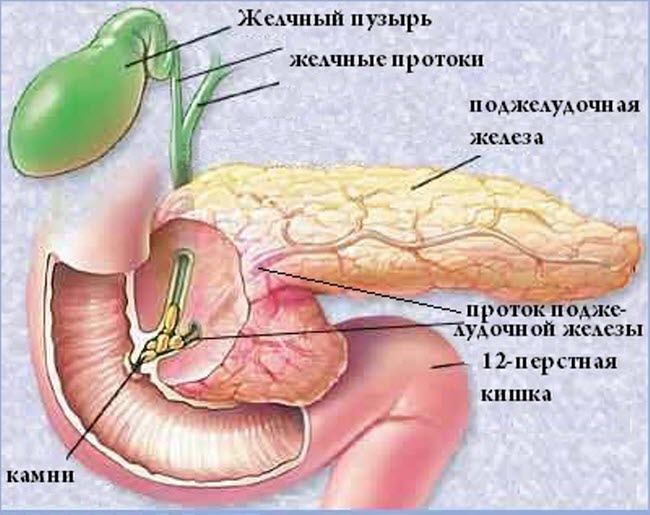 kamni-podzheludochnoj-zhelezy4