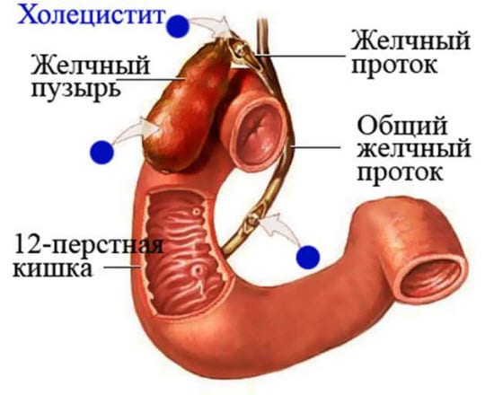 операция холецистэктомия лапароскопическая операция холецистэктомия лапароскопическая