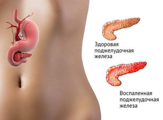 панкреатит что это такое симптомы и лечение панкреатит что это такое симптомы и лечение
