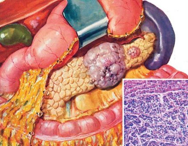 rak-podzheludochnoj-zhelezy-simptomy-proyavlenie