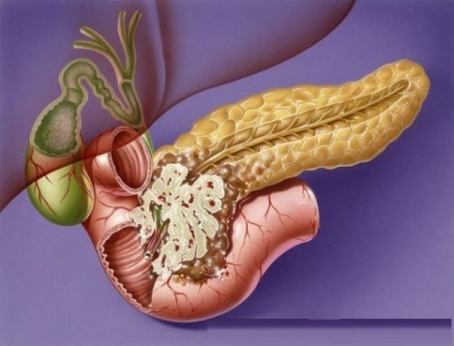 rak-podzheludochnoj-zhelezy-simptomy-proyavlenie1