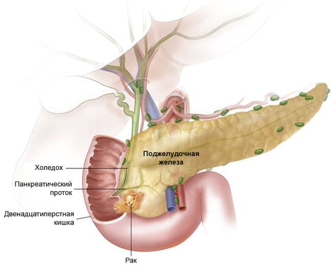 rak-podzheludochnoj-zhelezy-simptomy-proyavlenie6
