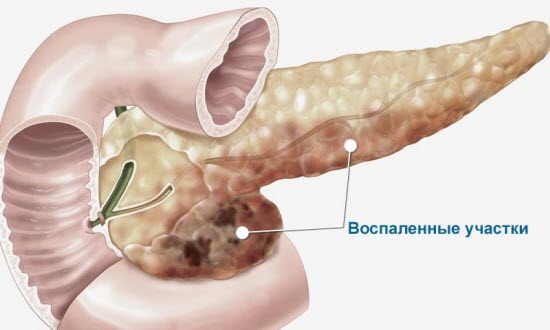 симптомы и признаки острого и хронического панкреатита симптомы и признаки острого и хронического панкреатита